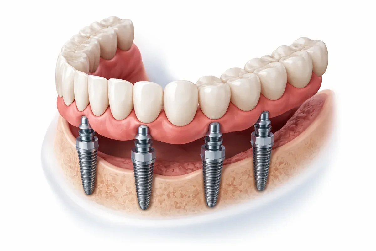 All 4 on 4 Dental Implants: A Complete Guide 5 all 4 on 4 dental implants