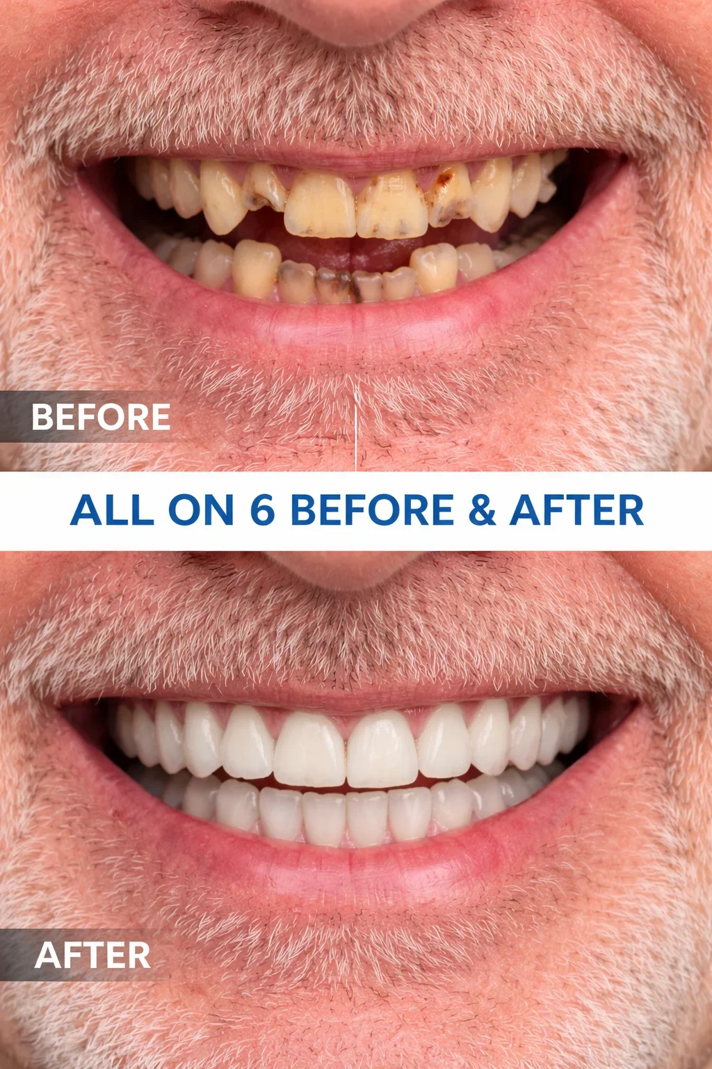 All on 6 Before and After: What to Expect from Start to Finish 5 all on 6 before and after