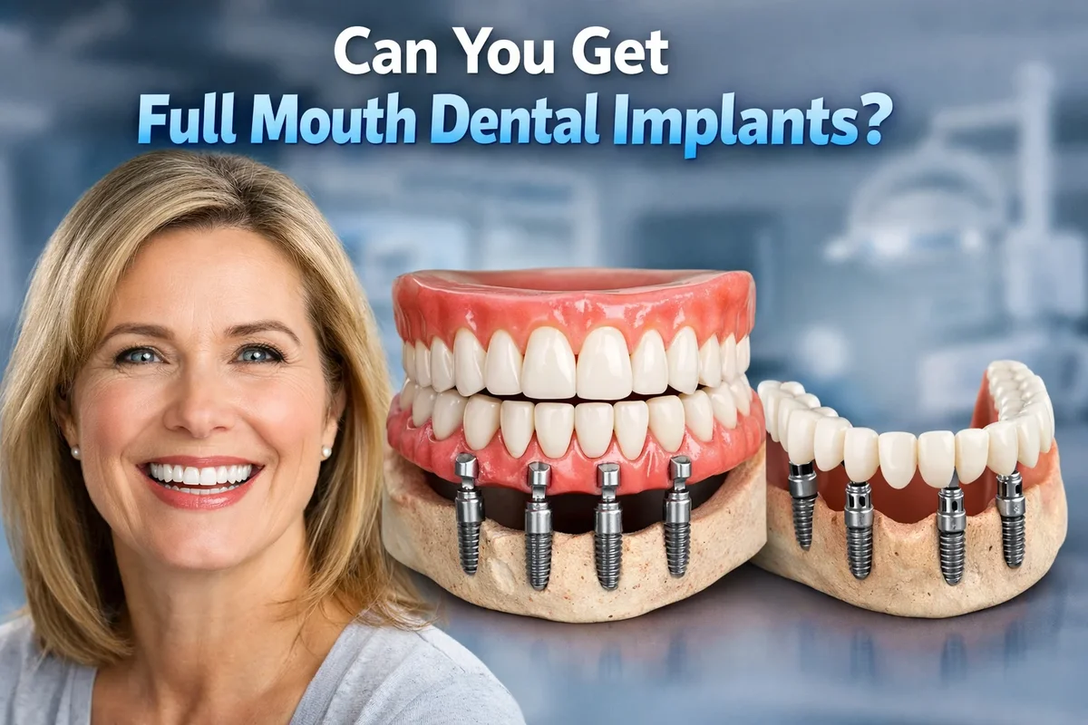 can you get full mouth dental implants