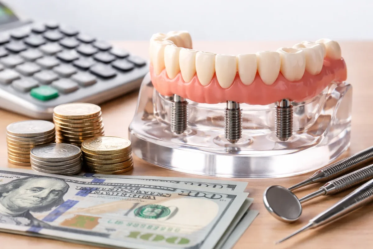 Cost of 4 on 4 Dental Implants: Complete Patient Guide 5 cost of 4 on 4 dental implants