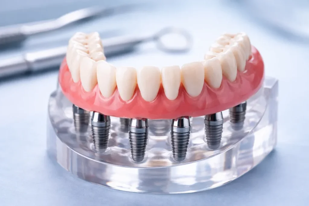 Full Set of Implants: Complete Guide to Permanent Smile Restoration 4 full set of implants