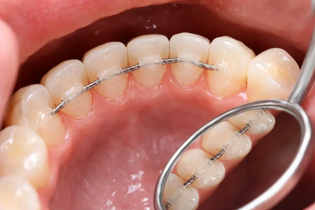 Lingual Retainer Orthodontics: Complete Guide for Long-Term Smile Stability 4 lingual retainer orthodontics