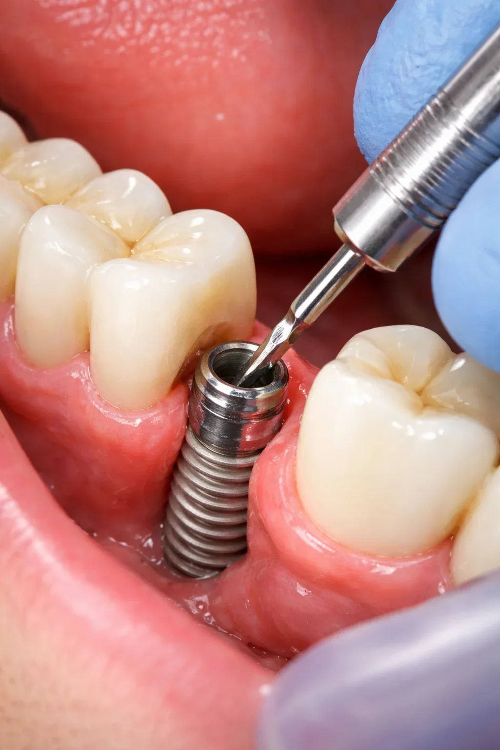 Loose Dental Implant Screws: Causes, Risks, and Solutions 5 loose dental implant screws