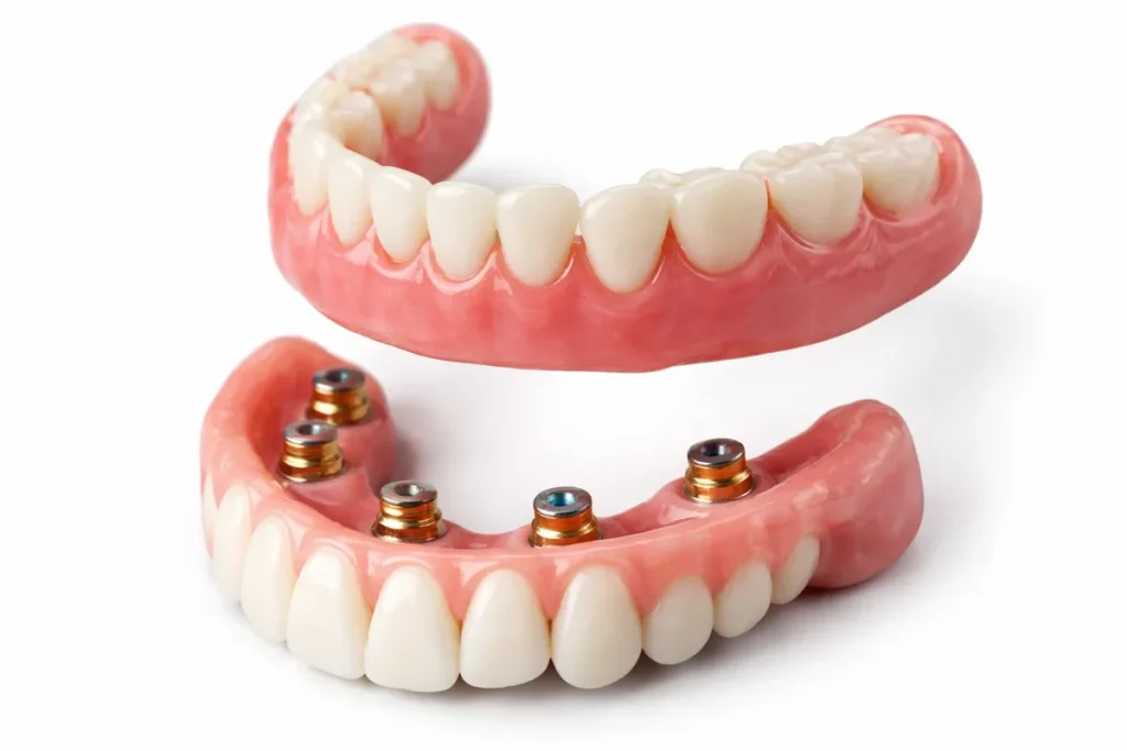 Maxillary Overdenture: A Complete Guide for Patients 4 maxillary overdenture