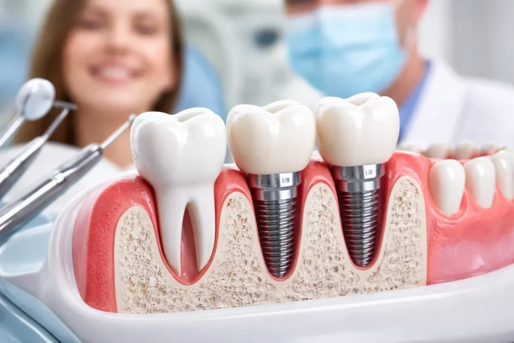 Oral Dental Implants: A Complete Guide to Modern Tooth Replacement 4 oral dental implants
