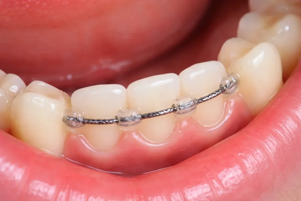 Permanent Lingual Retainer: Complete Guide After Braces 4 permanent lingual retainer