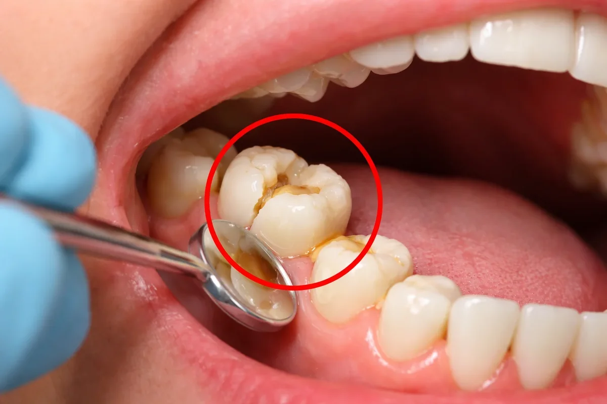Temporary Crown Broken: Causes, Risks, and What to Do 5 temporary crown broken