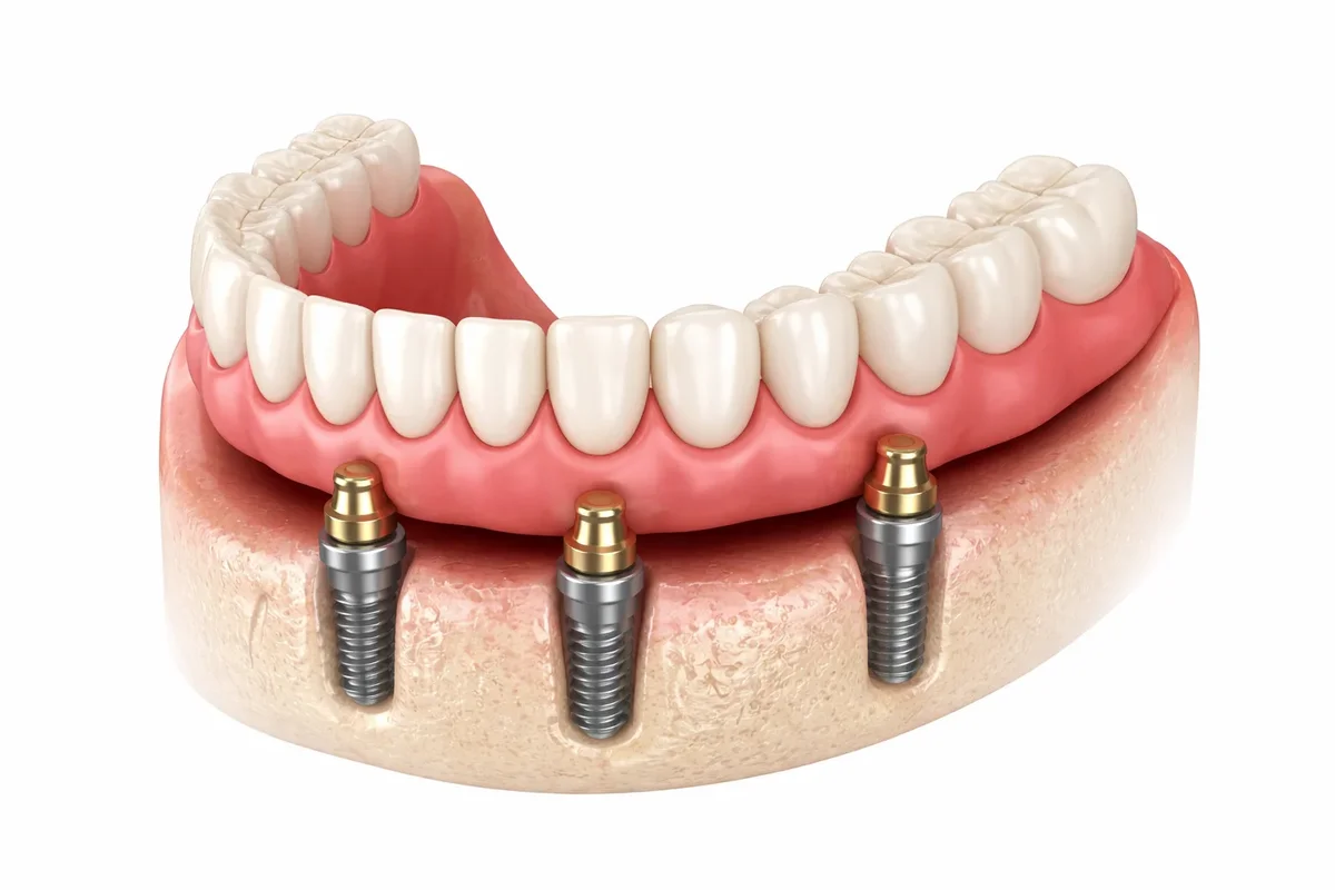 All on 3 Dental Implants: Complete Guide for a Confident Smile 5 all on 3 dental implants