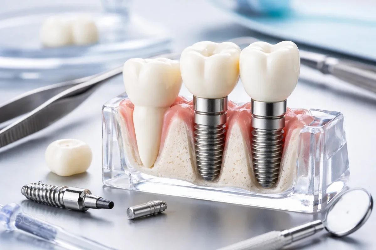Custom Dental Implants: Complete Guide for Perfect Smile 5 custom dental implants
