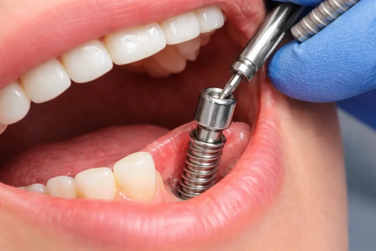 Dental Implant Second Stage: 9 Key Facts You Must Know 5 dental implant second stage