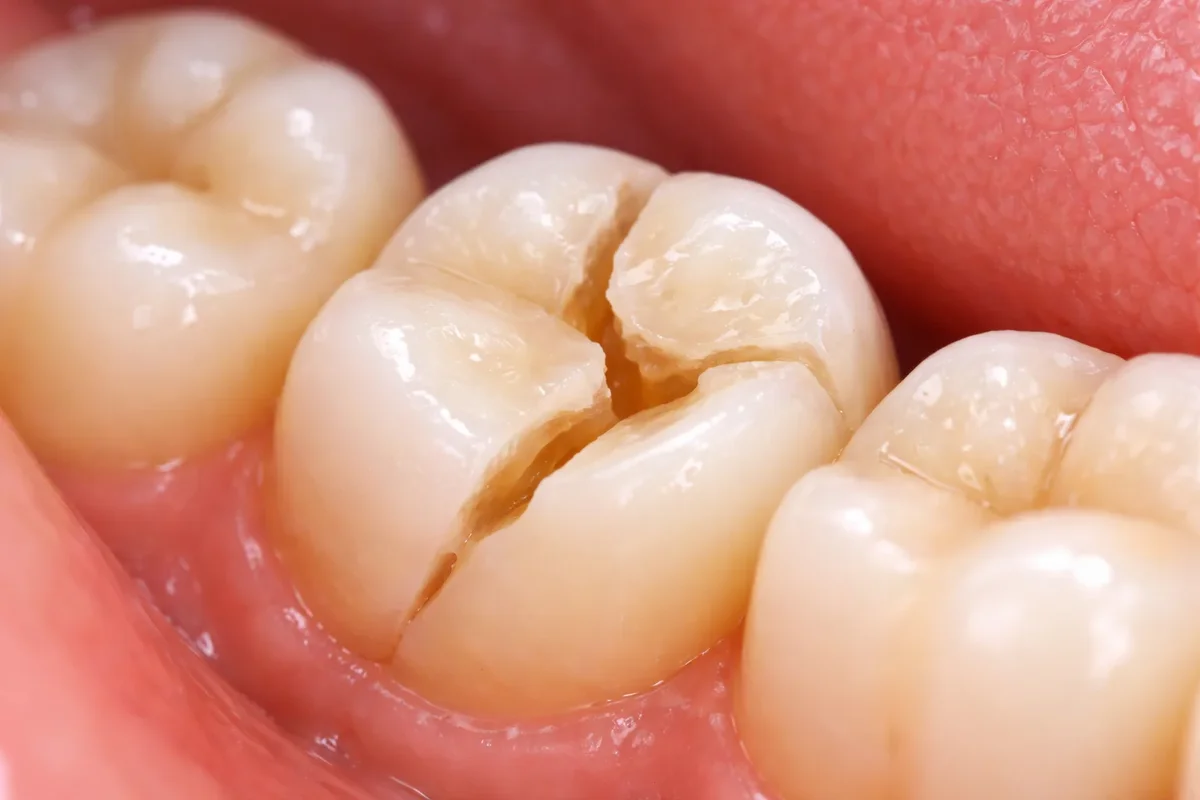 Fractured Crown: Causes, Symptoms, and Best Solutions 5 fractured crown