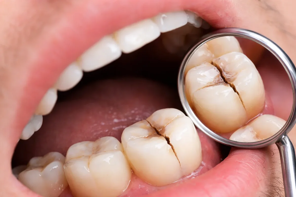 My Crown Cracked: Causes, Symptoms, and What You Should Do Immediately 5 my crown cracked