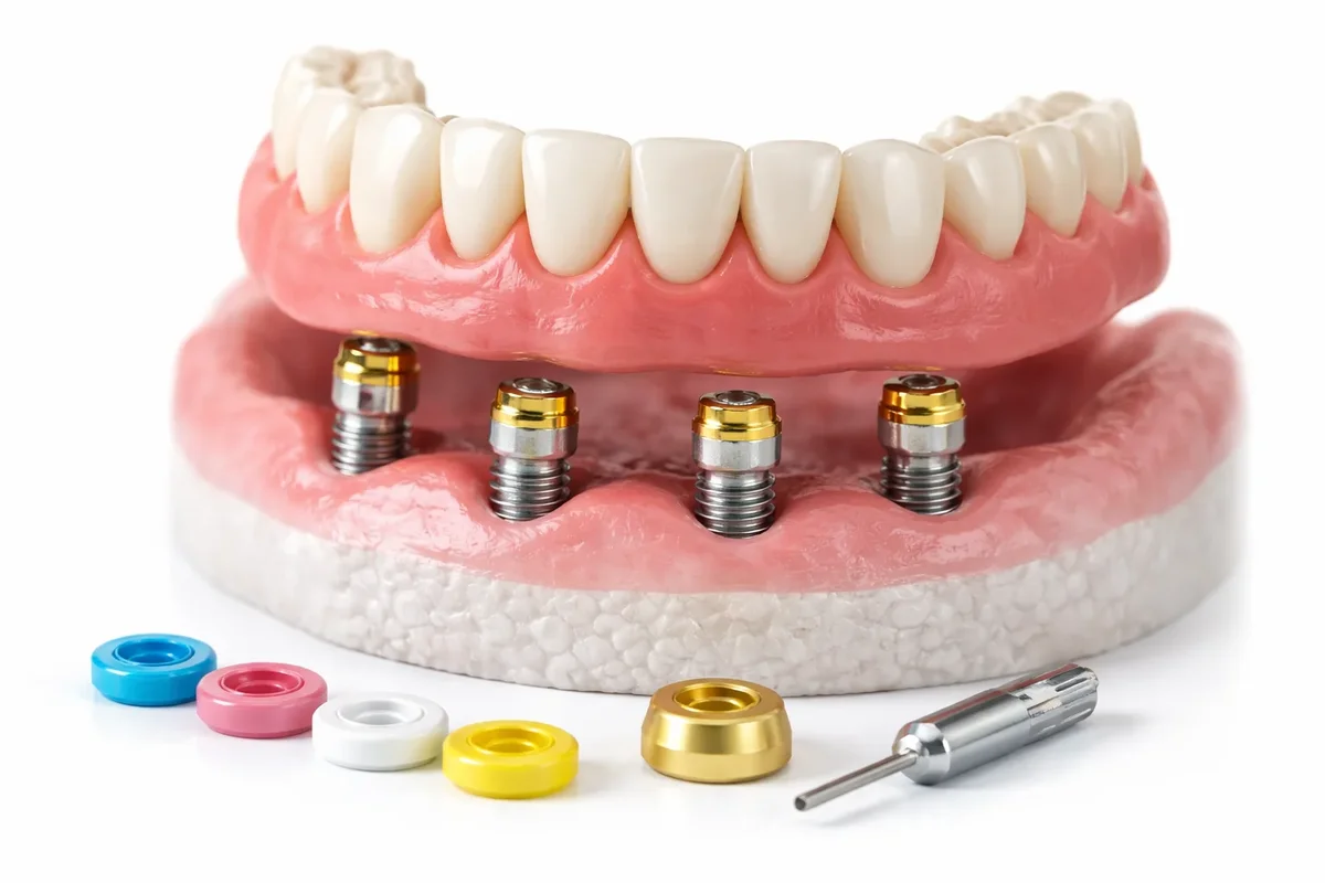 Novaloc Overdenture: Complete Guide for Stability & Comfort 5 novaloc overdenture