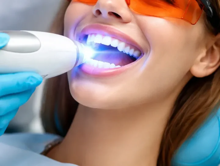 Zahnbleaching mit Laser: Strahlend weiße Zähne schnell & sicher 4 zahnbleaching mit laser