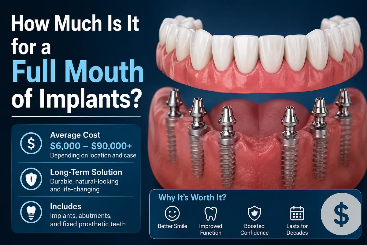 How Much Is It for a Full Mouth of Implants? 5 how much is it for a full mouth of implants