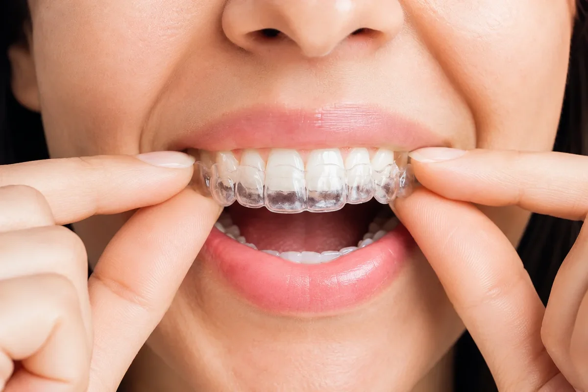 Invisalign in Mouth: 9 Facts You Should Know 5 invisalign in mouth