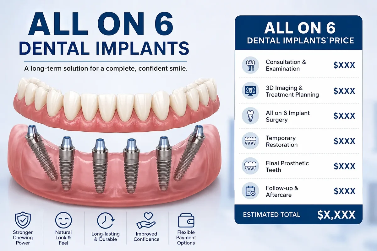 All on 6 Dental Implants Price: What You Should Know Before Making a Decision 5 all on 6 dental implants price
