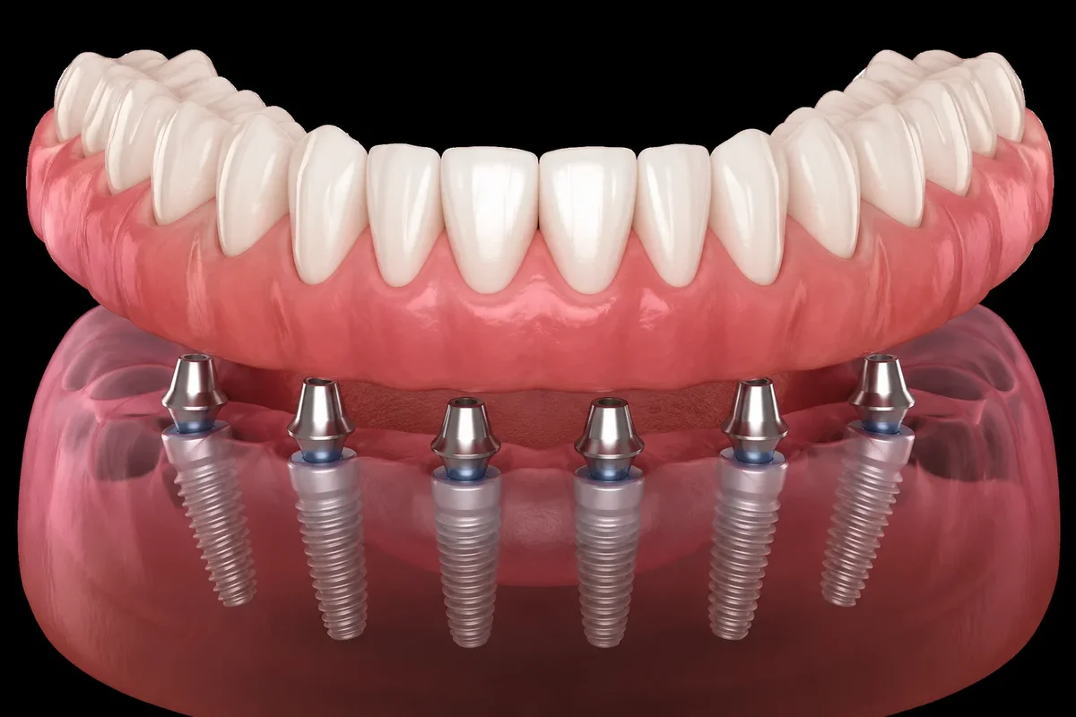 Full Arch Porcelain Dental Implants 5 full arch porcelain dental implants