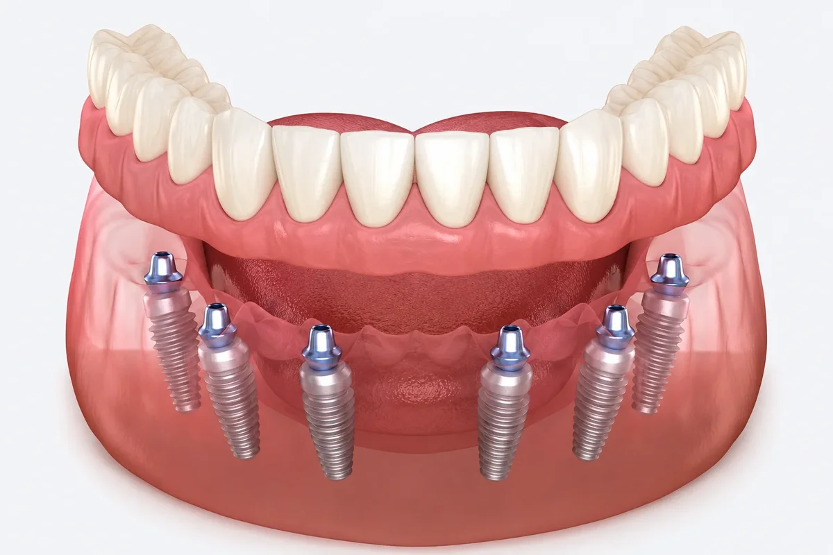 Full Bottom Dental Implant 5 full bottom dental implant