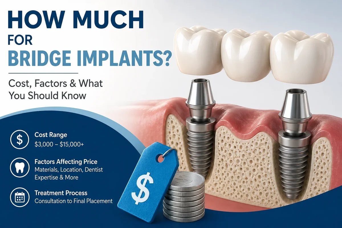 How Much for Bridge Implants? 5 how much for bridge implants