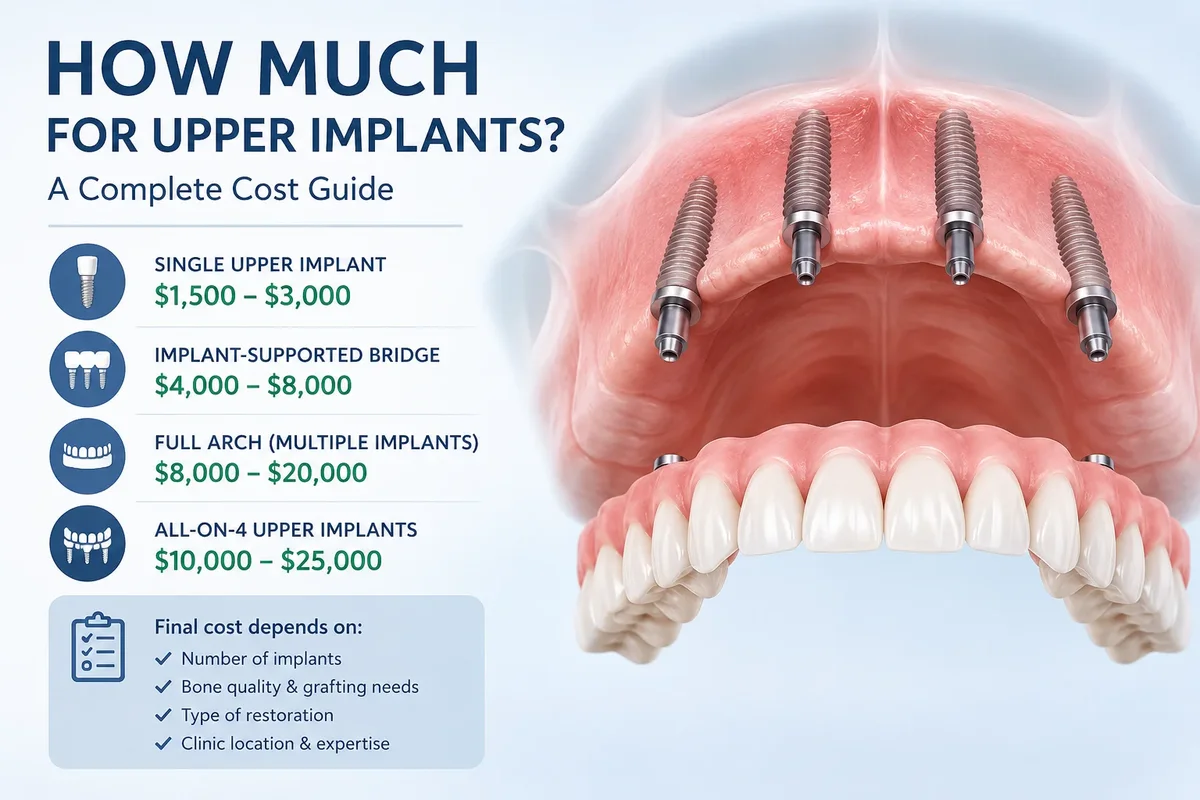 How Much for Upper Implants? A Practical Guide for Patients 5 how much for upper implants