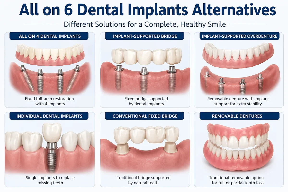 All on 6 Dental Implants Alternatives 5 all on 6 dental implants alternatives