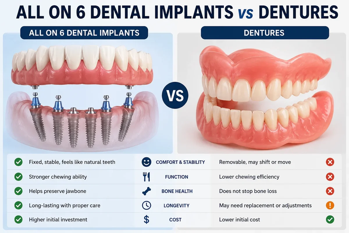 All on 6 Dental Implants vs Dentures 5 all on 6 dental implants vs dentures