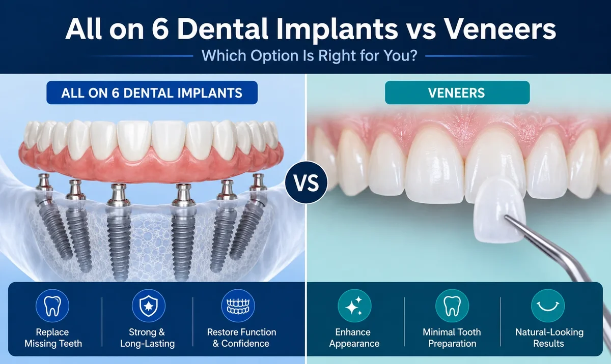 All on 6 Dental Implants vs Veneers 5 all on 6 dental implants vs veneers
